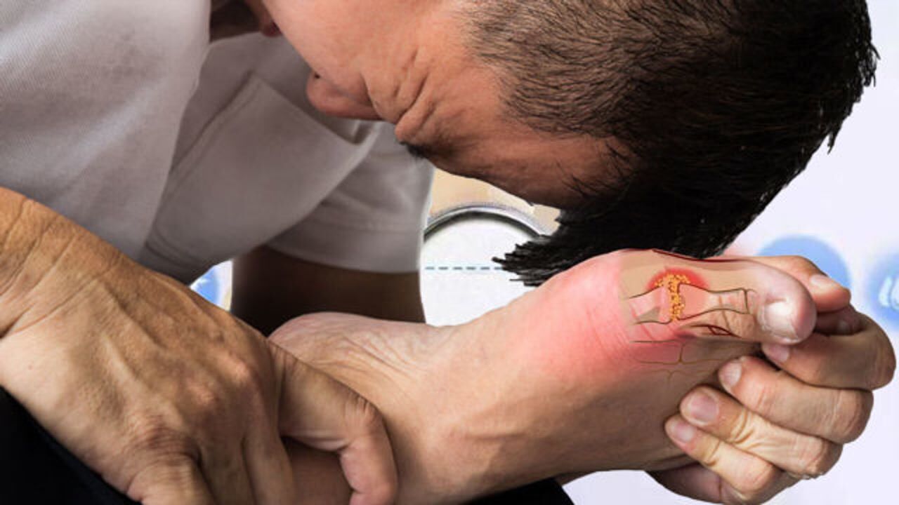 高尿酸血症竟然会带来这么严重的症状,比三高还严重!