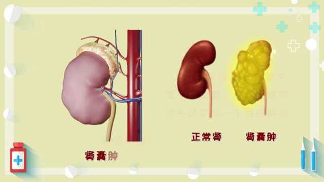 肾癌科普系列短片2:肾癌的表现及诊断