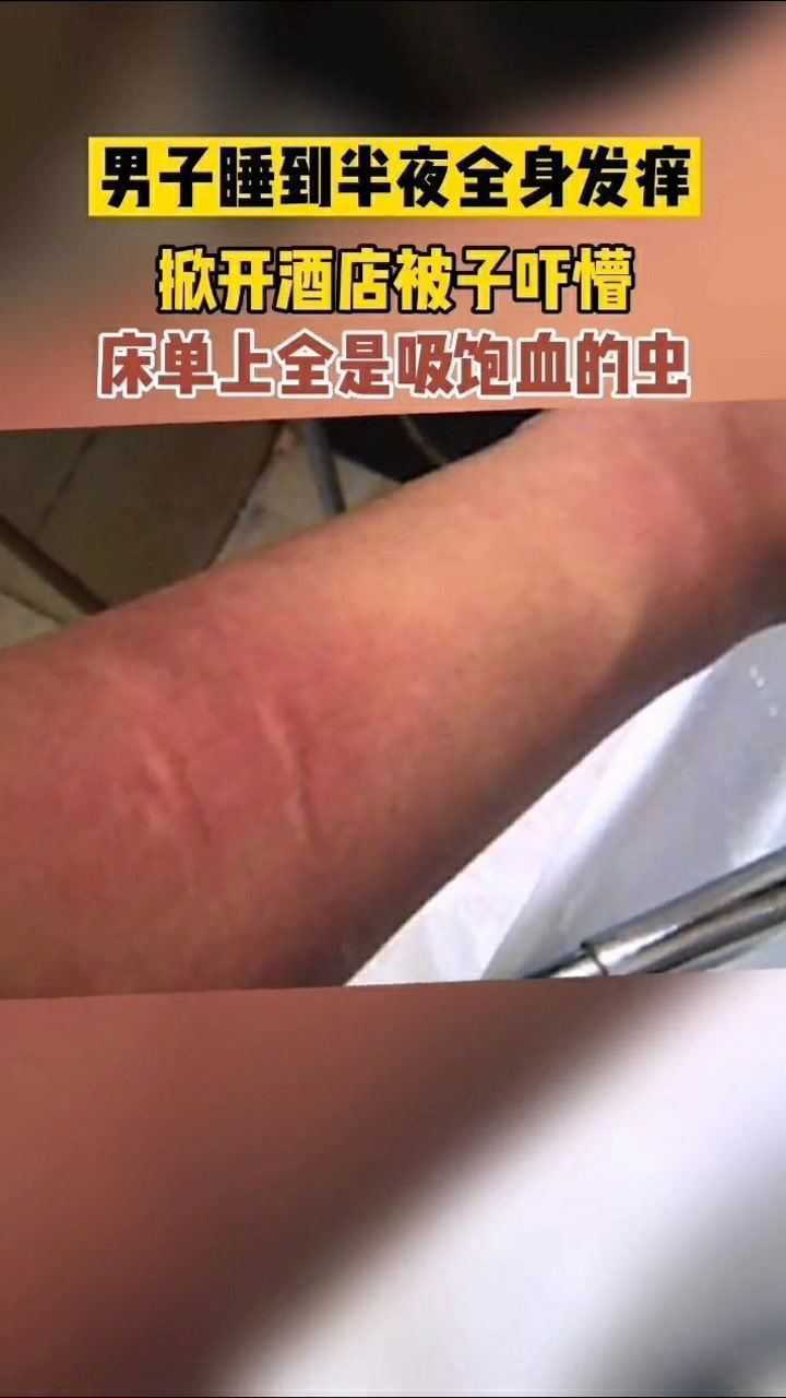 酒店睡到半夜全身發癢男子掀開被子懵了全是吸飽血的蟲