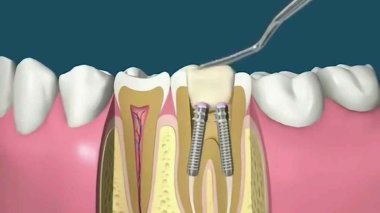 有一种疼叫根管治疗,看完我牙都酸了