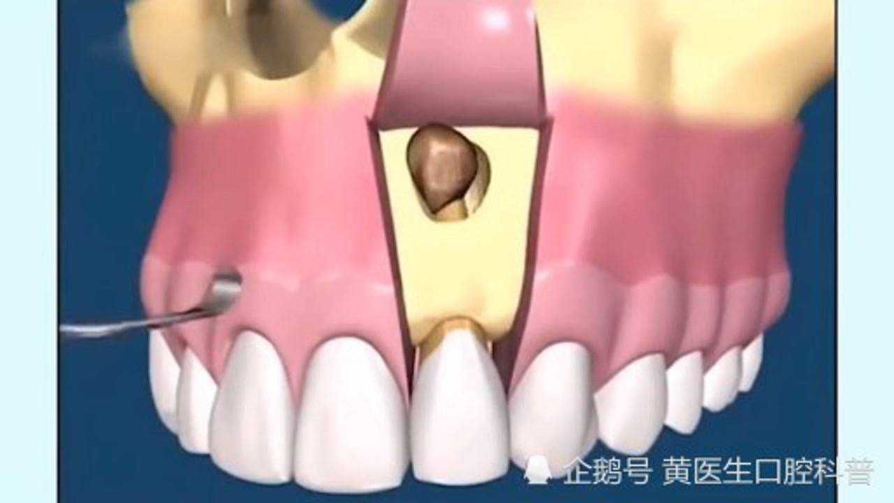 根尖囊肿会慢慢腐蚀牙根严重了可能会导致拔牙一旦发现及时处理哦