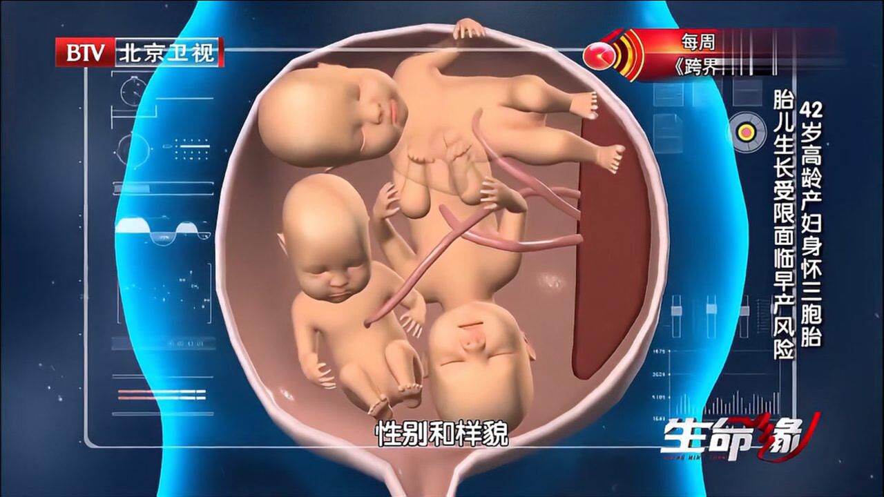 高龄产妇身怀单卵三胞胎,肚皮都撑花了,孕25周时竟出现严重问题