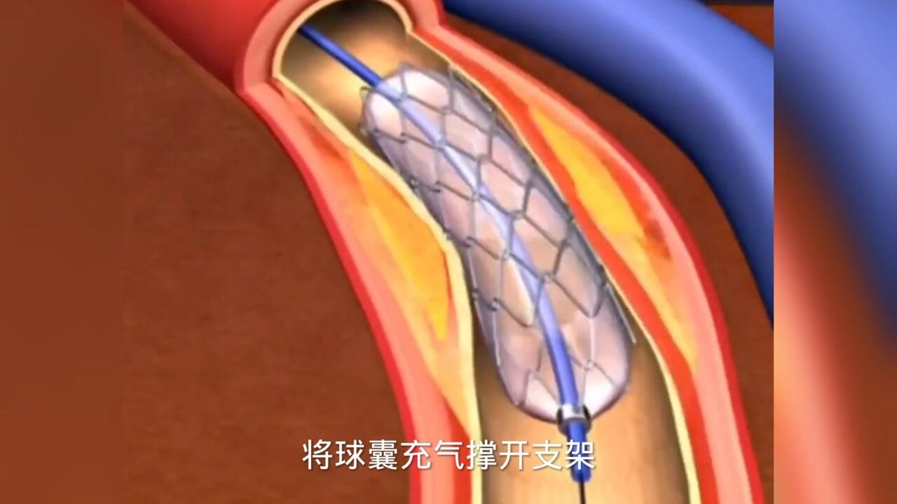心脏支架是如何放入人体的看完科学的解释心服口服