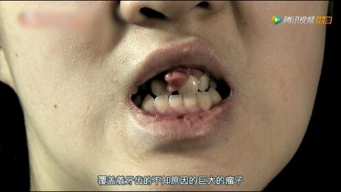 Let美人：女子牙龈长了巨大瘤子，每次吃东西时，就不断会流血