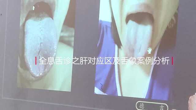 全息舌诊之肝对应区及舌象案例分析 