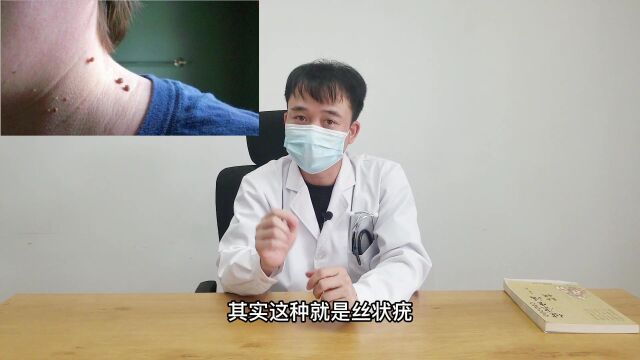 脖子上长了很多丝状的“小肉丁”,这种是丝状疣,教你一招解决