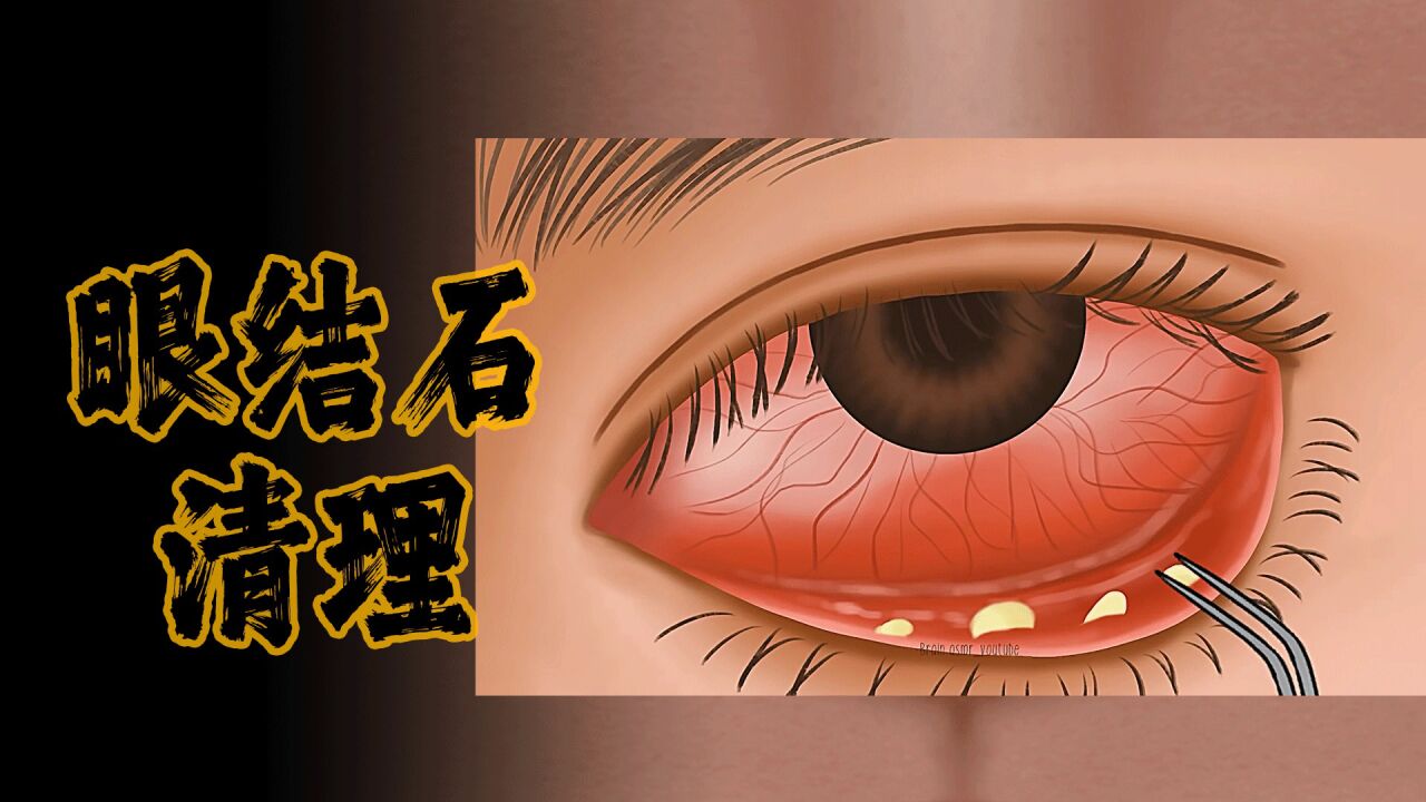 眼结石清理过程