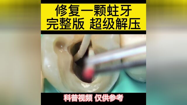 修复一颗龋齿|完整版