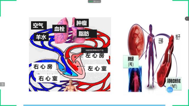 VTE的预防及护理黄星