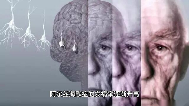 阿尔兹海默症是什么?