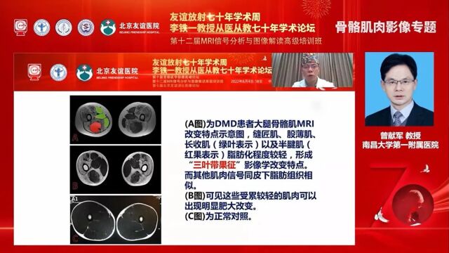 肌肉病的MRI评价南昌大学第一附属医院曾献军