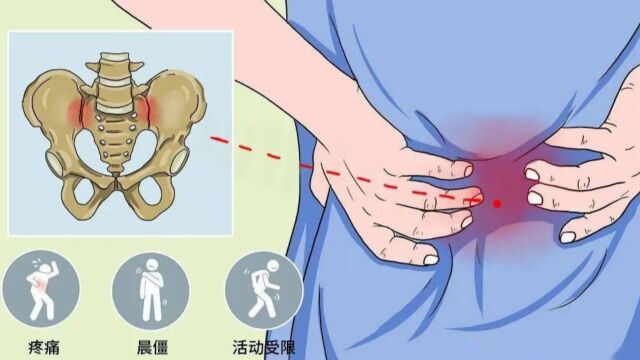 这不是腰痛、屁股痛,这是骶髂关节不适,每天3个动作强化稳定