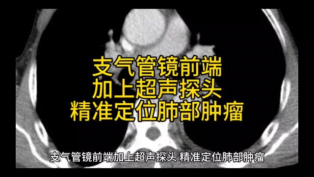 支气管镜前端加上超声探头,精准定位肺部肿瘤