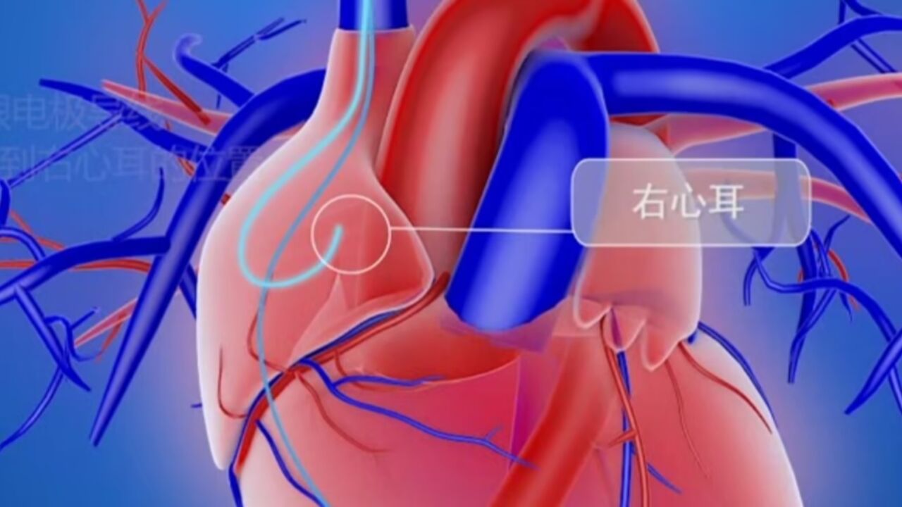 永久起搏器植入术-泰达心血管病医院