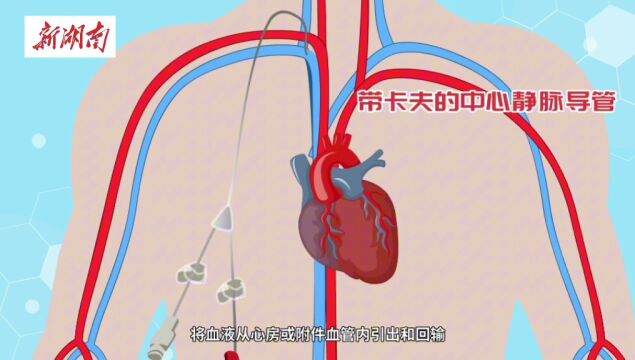 科普视频|保护血管通路——血液透析患者的"生命线"