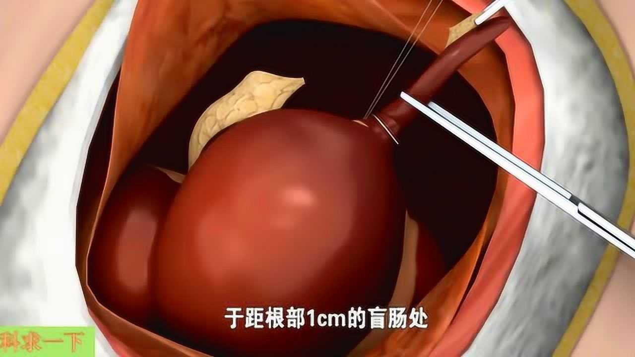 3d演示阑尾炎手术过程看看阑尾长什么样的如何被切除的