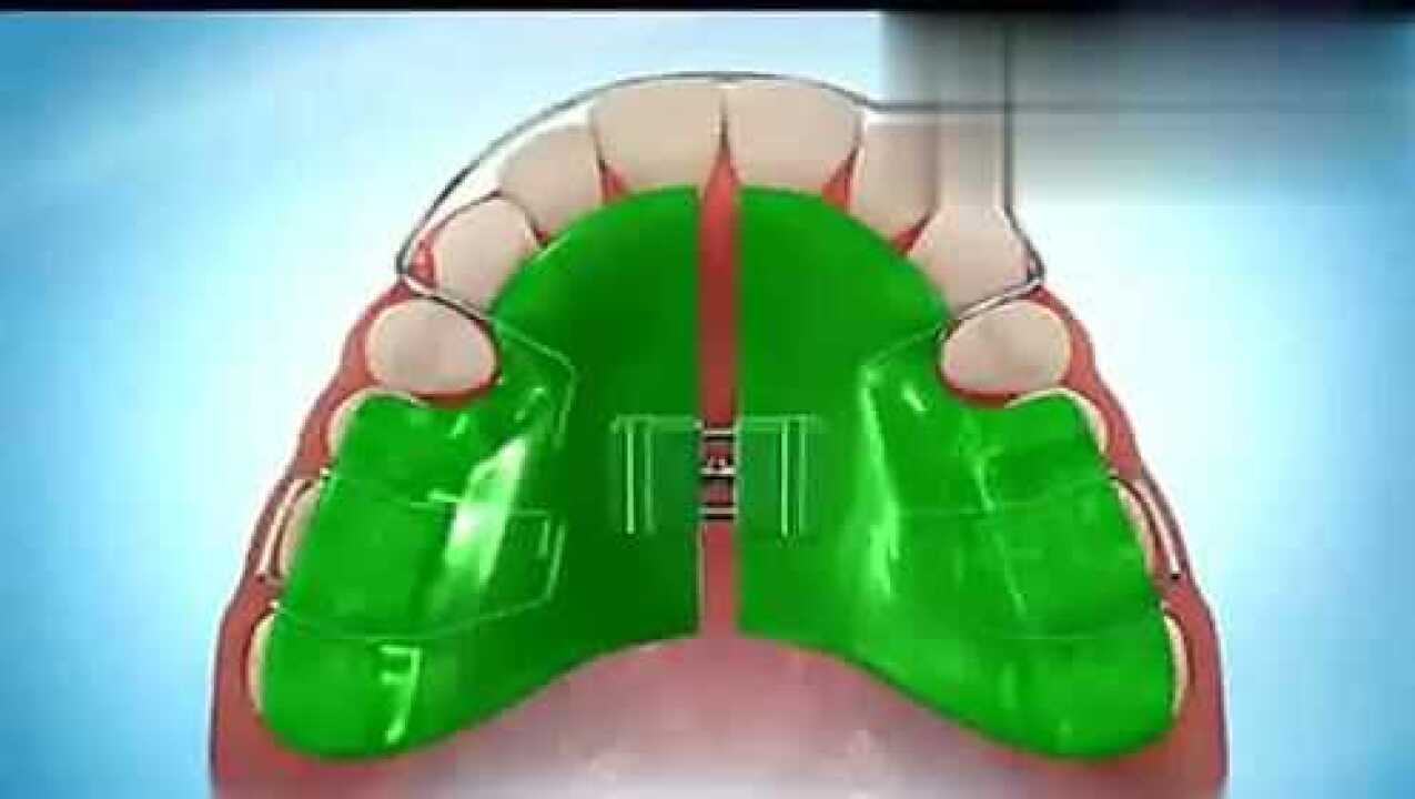 医学3D动画:演示正畸扩弓器矫治牙齿过程!好好珍惜牙齿吧_高清1080P在线观看平台_腾讯视频