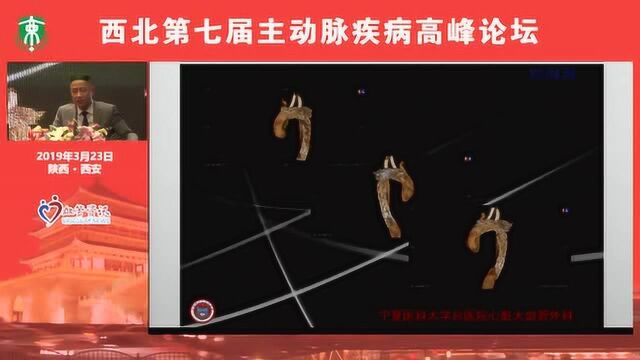 李晓东 体外开窗案例分析