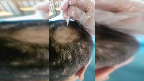 斑秃患者局部注射药物防止脱发,促进头发再生