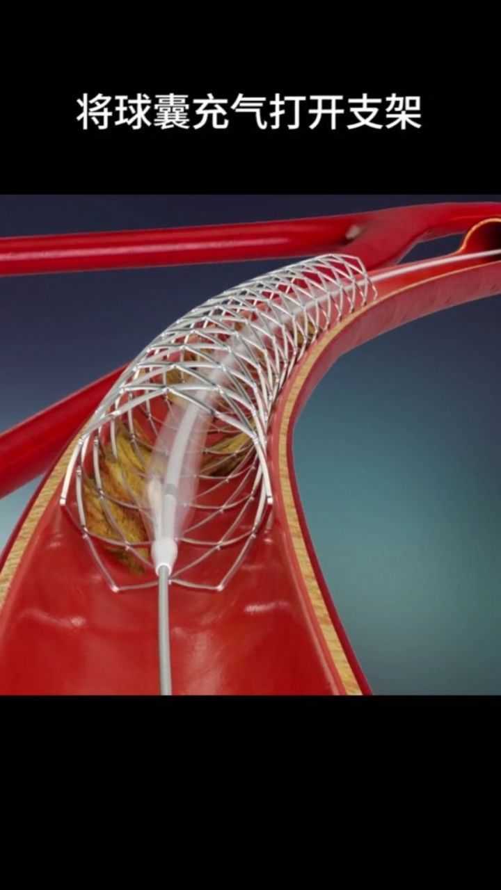 心脏支架是这样被放入人体的
