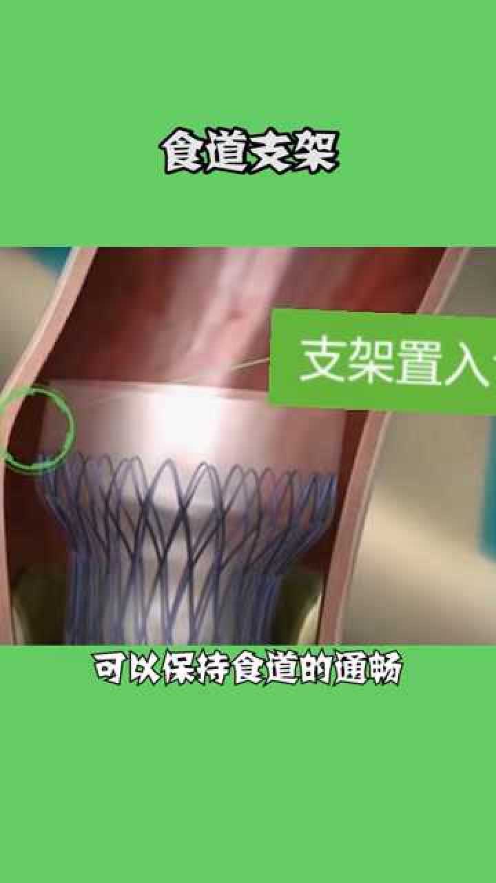 食管气管瘘支架图片