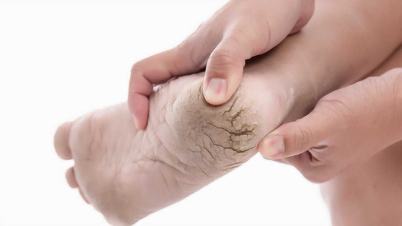 脚后跟总是干裂起皮不光是缺乏维生素提醒还有这3大病因