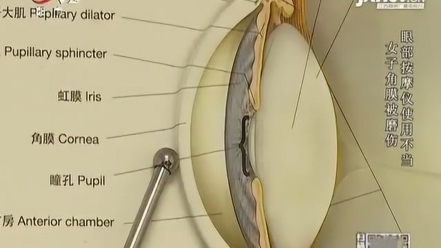 女子使用眼部按摩仪竟舒服睡着,长时间的热敷,导致眼角膜被磨伤