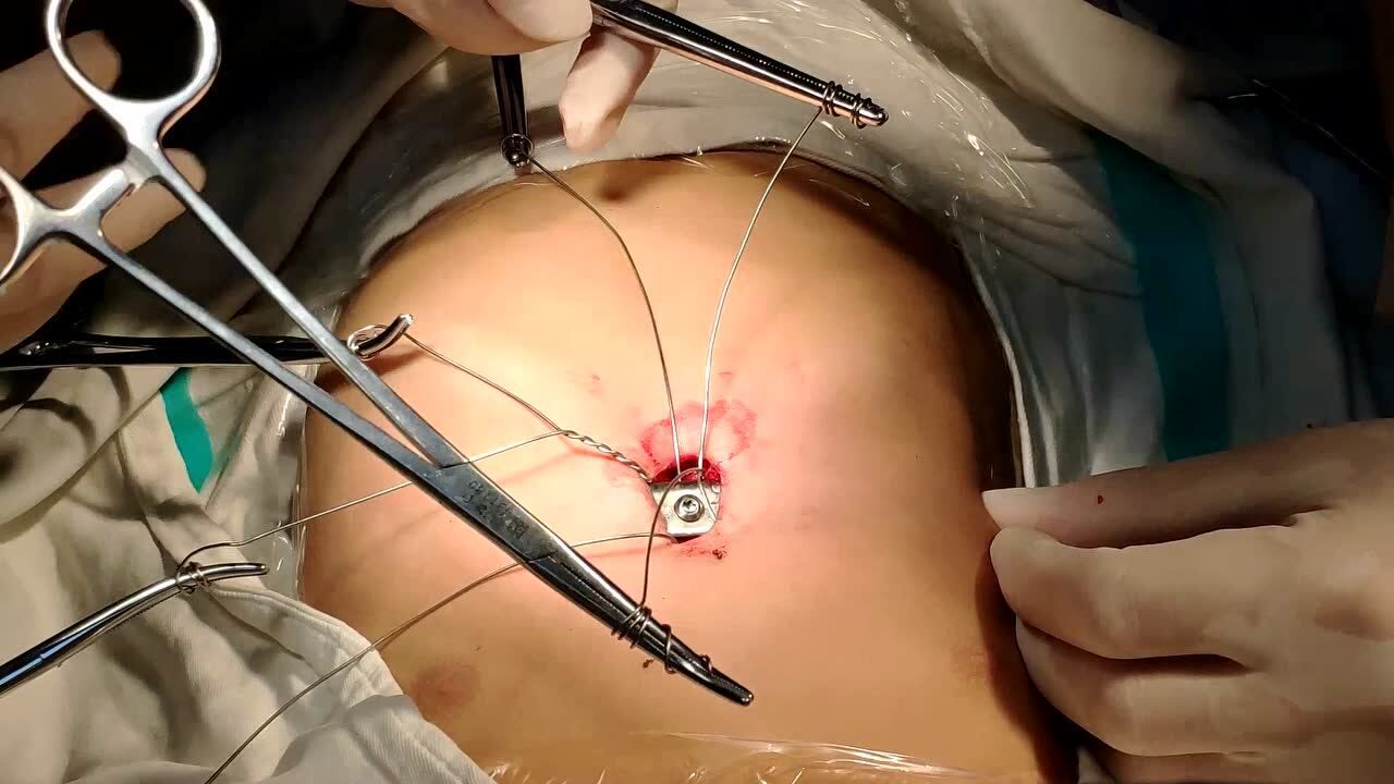 漏斗胸矫形wang手术视频