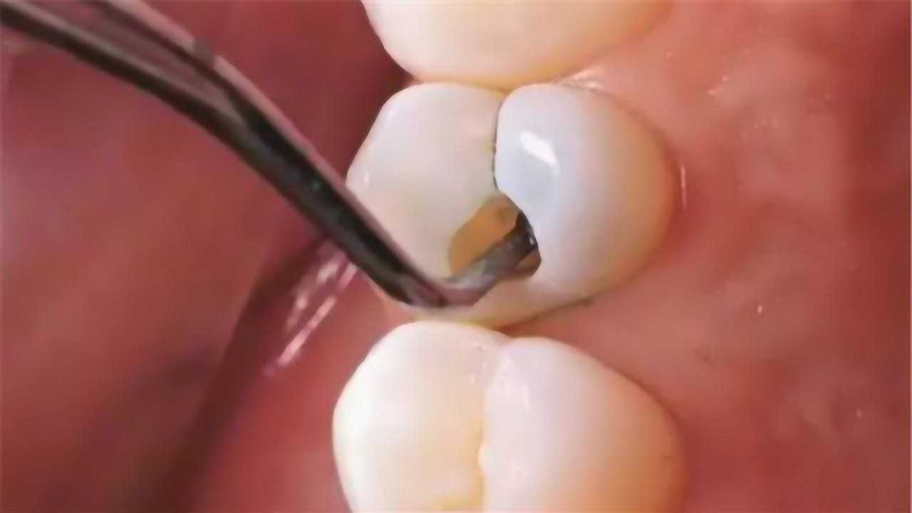 龋齿被拔出的瞬间到底有多轻松3d动画模拟全过程看完直呼过瘾