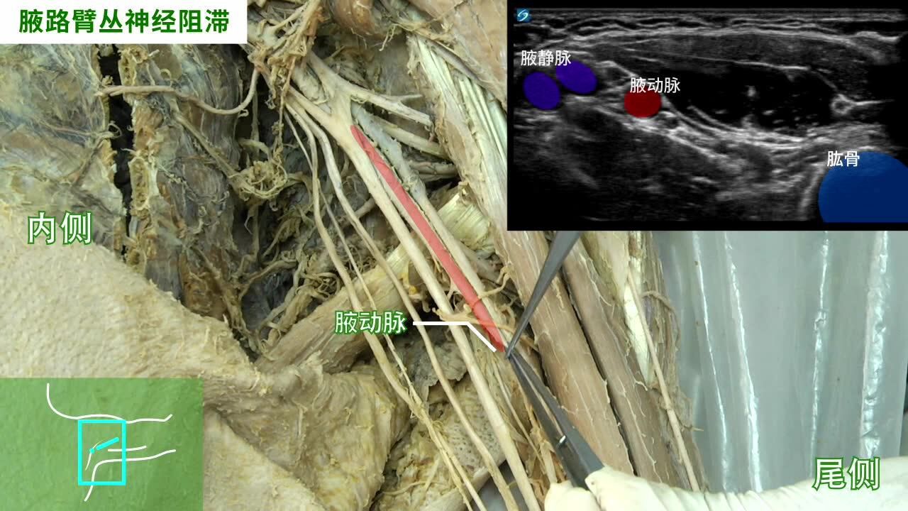 同济-索诺声合作微视频教学——超声引导下腋路臂丛神经阻滞_高清1080P在线观看平台_腾讯视频
