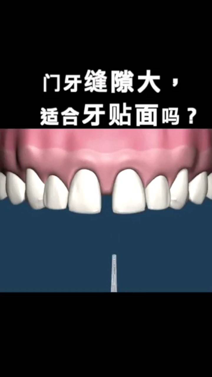 门牙缝隙大,第二种关缝方法