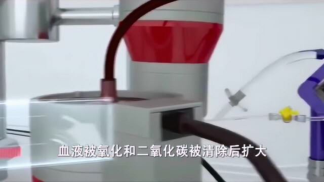 一段视频带你了解现代医学神器——ECMO移动心肺仪