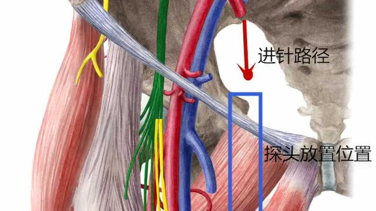 超声引导近端肌筋膜入路闭孔神经总支阻滞_腾讯视频
