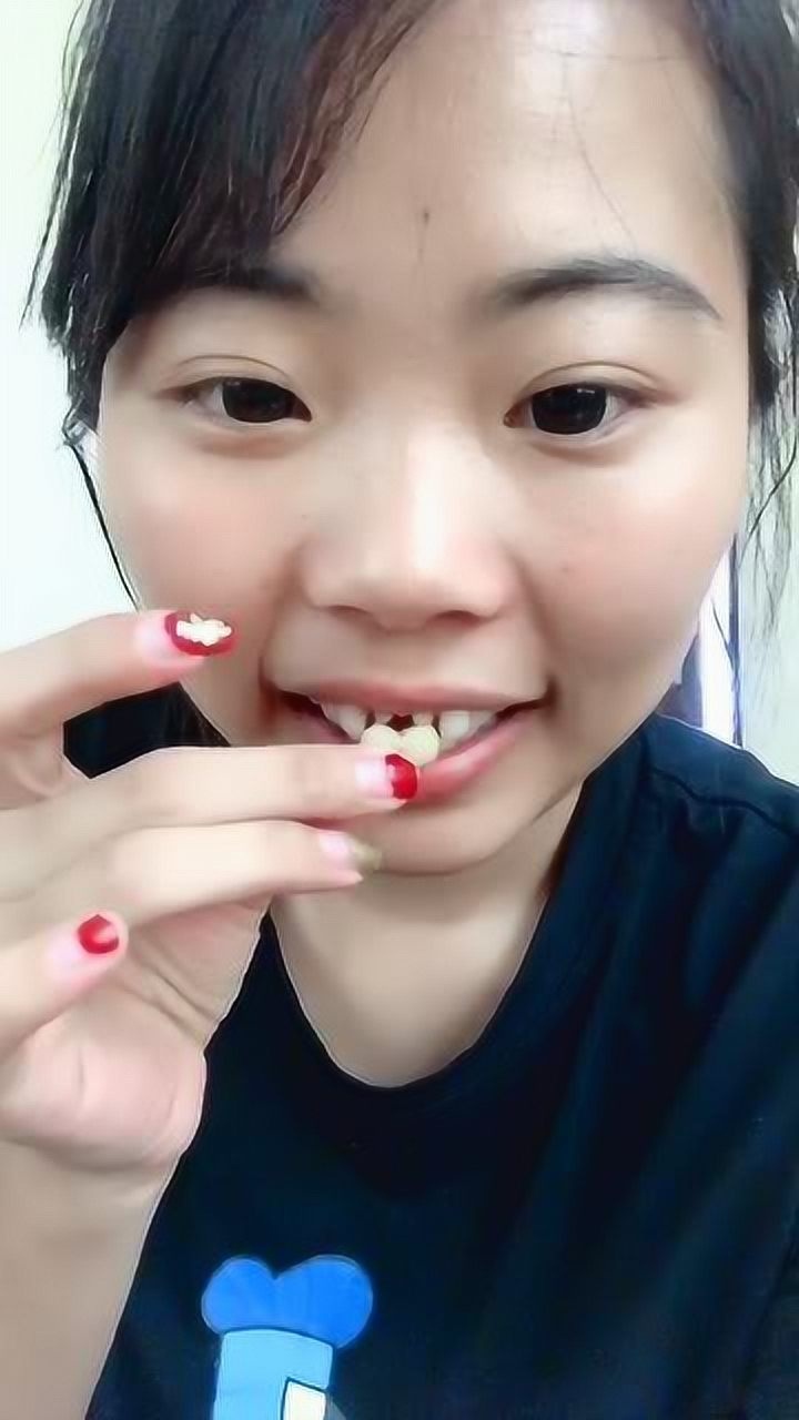 门牙磕掉了,装了这个假牙,现在好看多了!