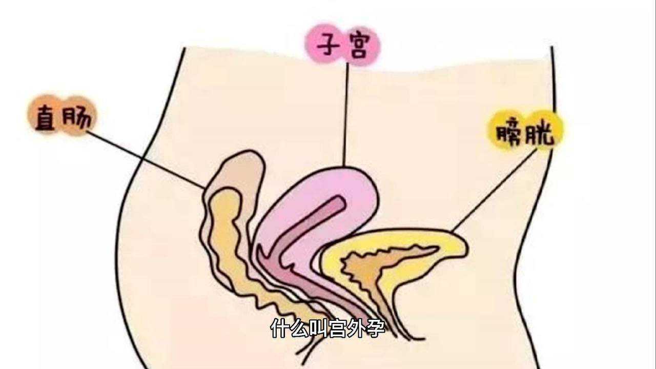 关于生育受精卵着床在子宫的什么位置什么叫宫外孕