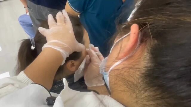 太阳穴刺血操作视频讲解