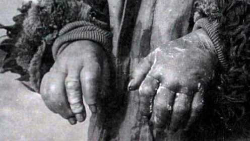731部队冻伤实验照片，手脚肿胀变黑，暴行令人愤怒