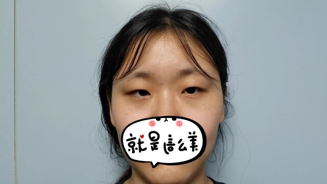 内双,肿眼泡,眶骨低,内眦赘皮,如何改善?详细讲解