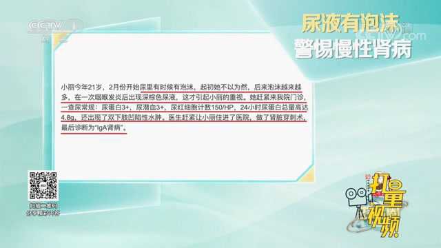 尿液出现泡沫,颜色呈深棕色,一查竟是lgA肾病在作怪