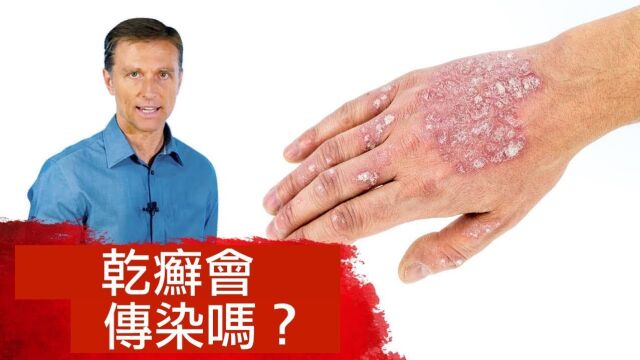 乾癣(牛皮癣)会传染吗?乾癣自然疗法, 柏格医生 Dr Berg