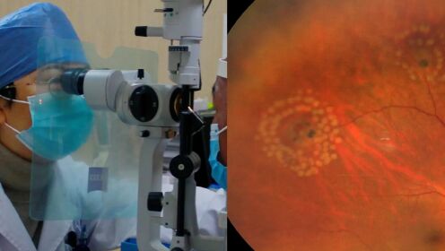 考研女生用眼过度视网膜破2个洞：本身高度近视，眼前总有黑影飘