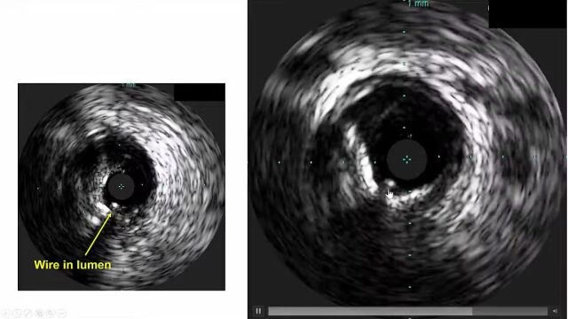 Case 5 Manual of CTO Interventions  IVUS guidance for retrograde CTO PCI