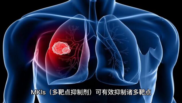 RET突变用药普拉替尼为RET突变肺癌患者带来新希望