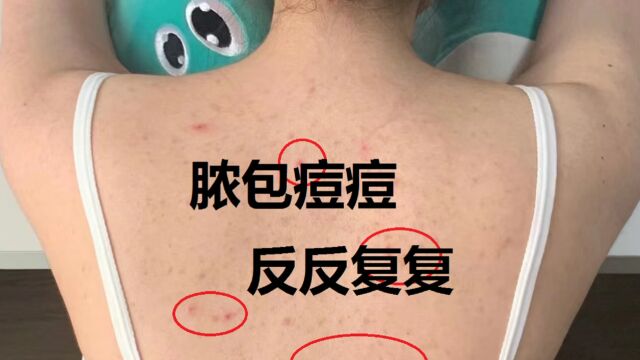 流脓的脓包怎么办?专家推荐这些祛痘方法,脓包痘痘就洗洗断根!