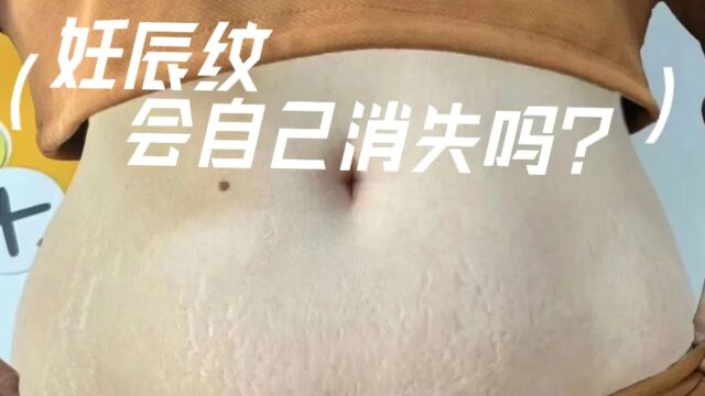 三年顽固妊娠纹如何淡化?过来人教你科学妙招,在家轻松搞定!