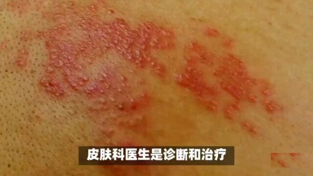 得了带状疱疹的症状和感受是什么?