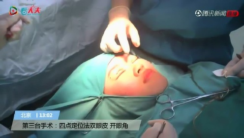 全程记录四点定位法小切口双眼皮 开眼角手术