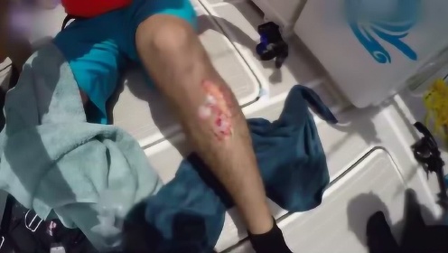 潜水男子海底被鲨鱼攻击，咬伤腿部深可见骨