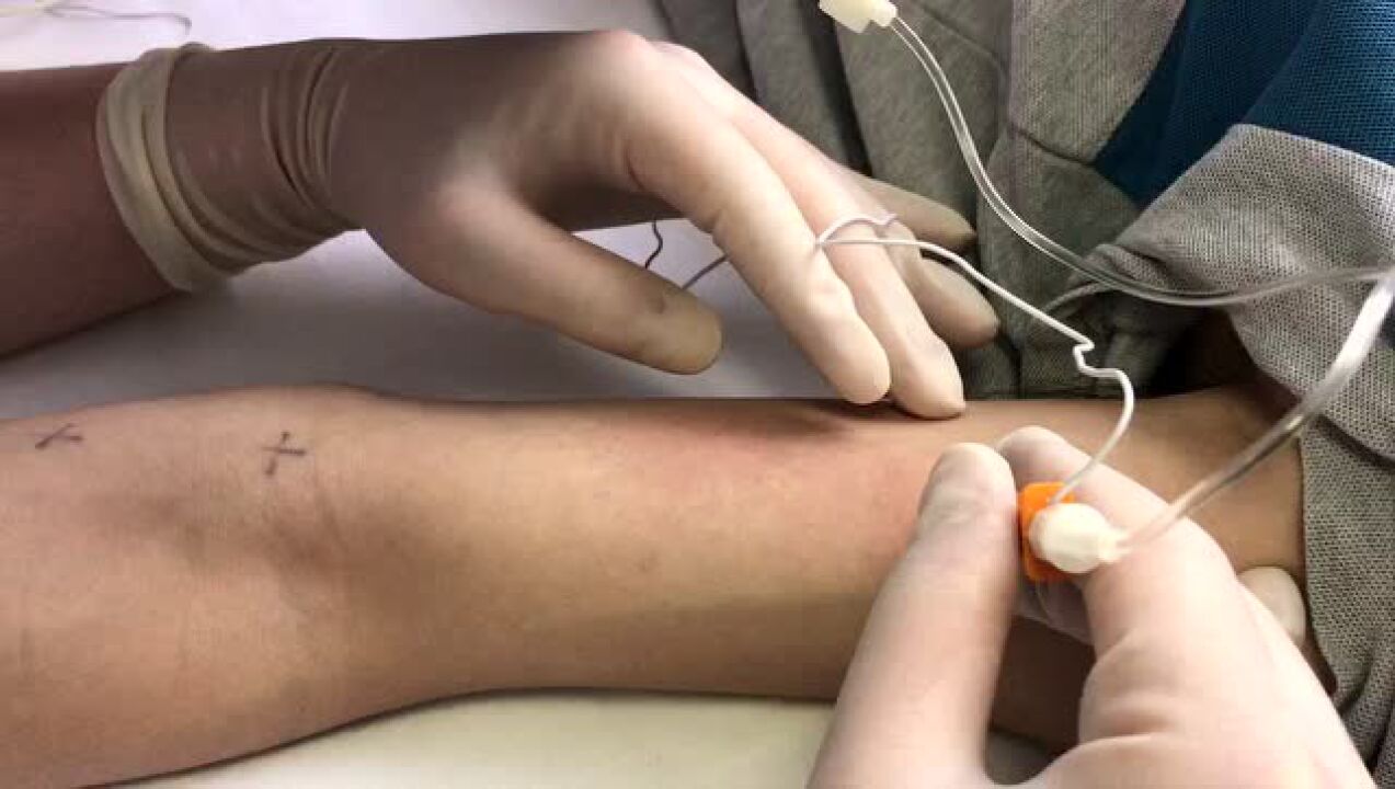 肉毒毒素注射肱二头肌