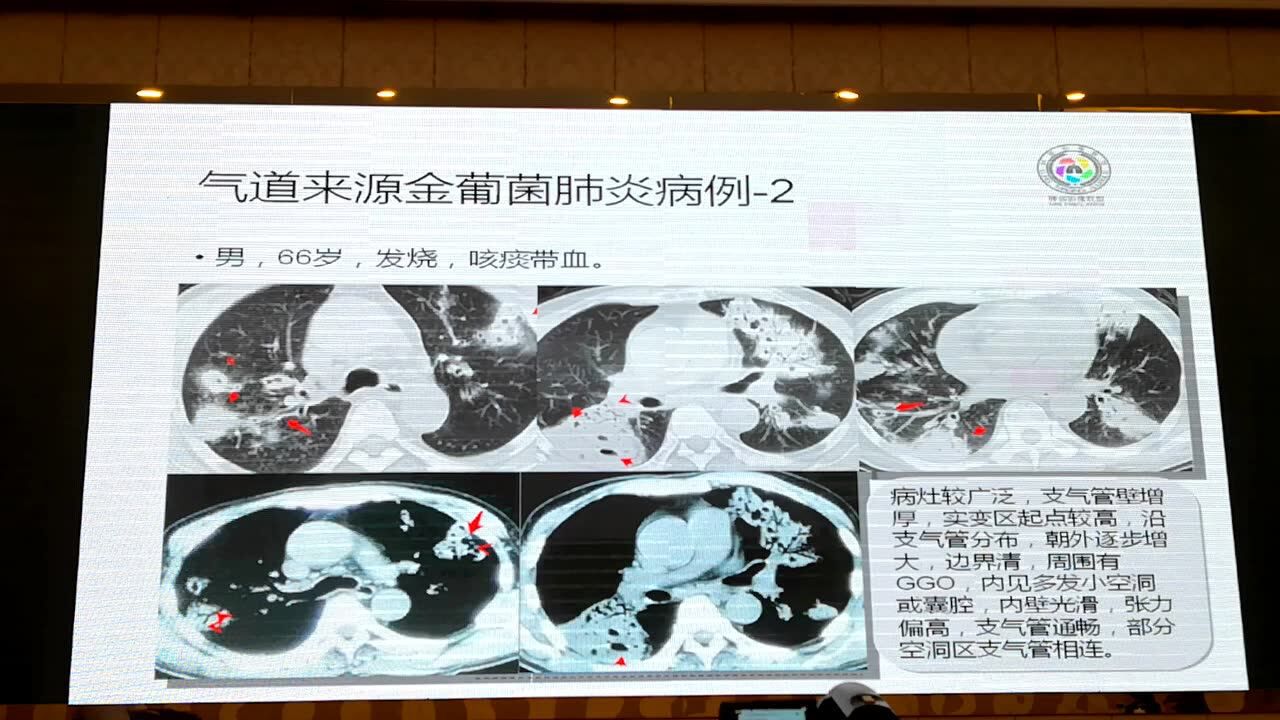 肺部影像联盟金葡菌肺炎的影像诊断